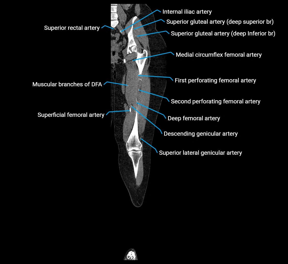 CTA lower limb coronal cross sectional anatomy labelled image _43 (2).webp